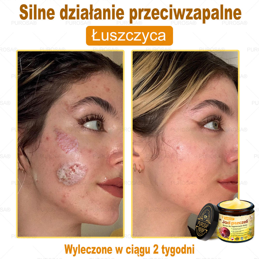 Utolsó esély! Már csak 5 tégely maradt a PUROSA® szuper kedvezményes ajánlatából! Most extra 50% kedvezménnyel teheted meg az első lépést a feszesebb és fiatalosabb bőr felé. Ha lemaradsz az idei akcióról, lehet, hogy soha többé nem találkozol hasonlóval!