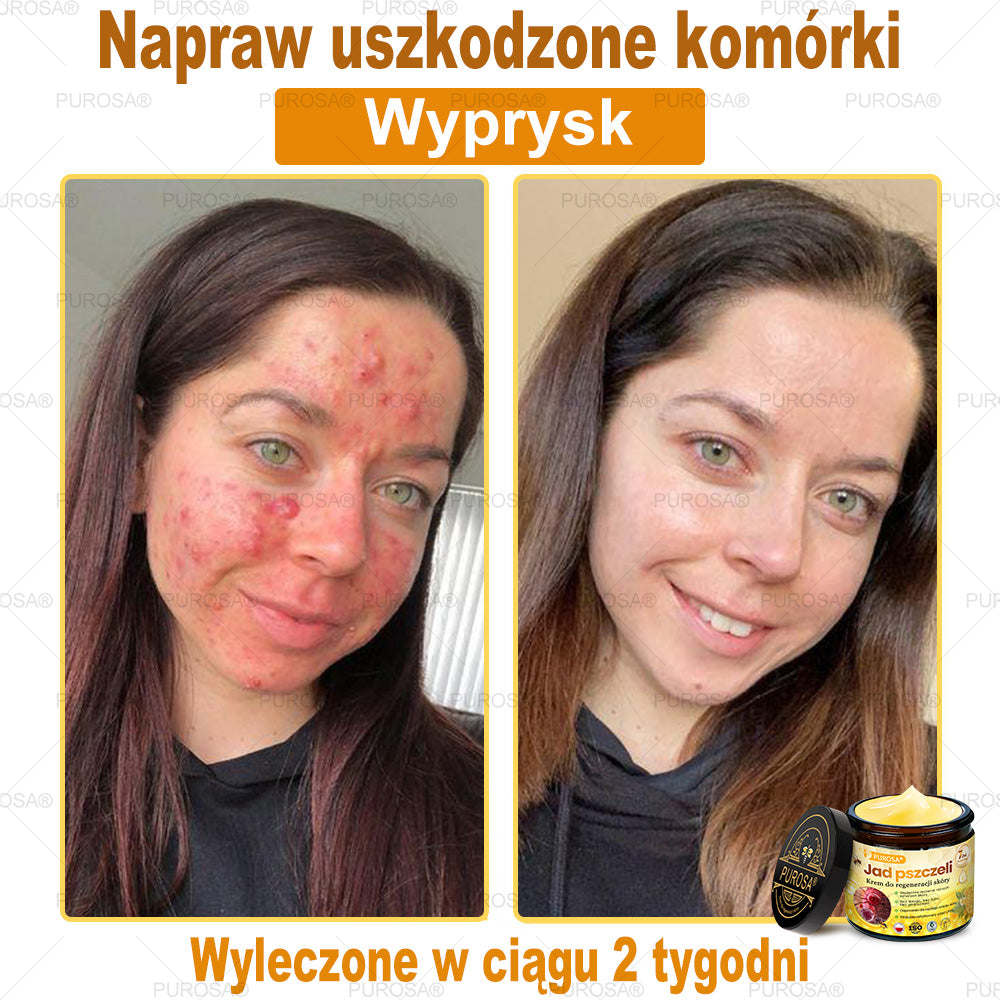 Utolsó esély! Már csak 5 tégely maradt a PUROSA® szuper kedvezményes ajánlatából! Most extra 50% kedvezménnyel teheted meg az első lépést a feszesebb és fiatalosabb bőr felé. Ha lemaradsz az idei akcióról, lehet, hogy soha többé nem találkozol hasonlóval!