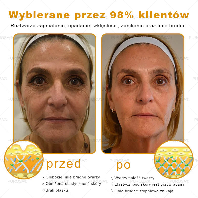 Utolsó esély! Már csak 5 tégely maradt a PUROSA® szuper kedvezményes ajánlatából! Most extra 50% kedvezménnyel teheted meg az első lépést a feszesebb és fiatalosabb bőr felé. Ha lemaradsz az idei akcióról, lehet, hogy soha többé nem találkozol hasonlóval!